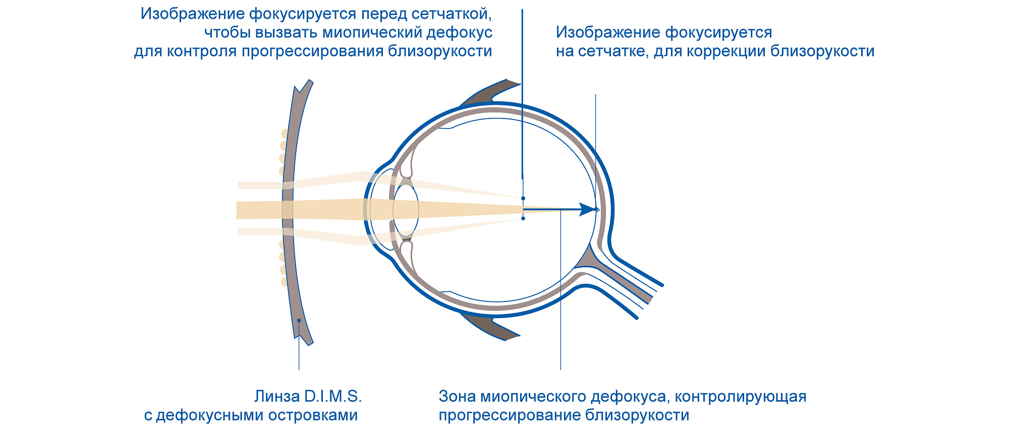MiYOSMART Hoya линзы для контроля миопии в Оптик-Центре.jpg MiYOSMART Hoya линзы для контроля миопии в Оптик-Центре.jpg